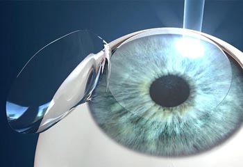 lasik doctor in Chintpurni